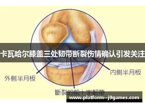 卡瓦哈尔膝盖三处韧带断裂伤情确认引发关注